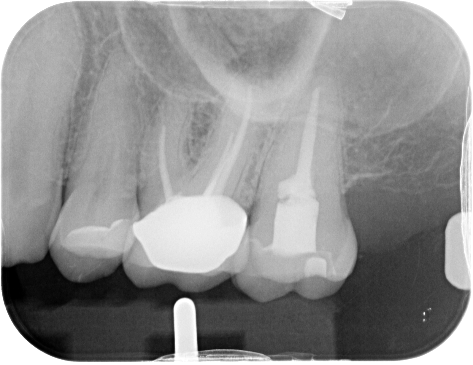 Grau wird wurzelbehandelter zahn Wurzelbehandlung Wie